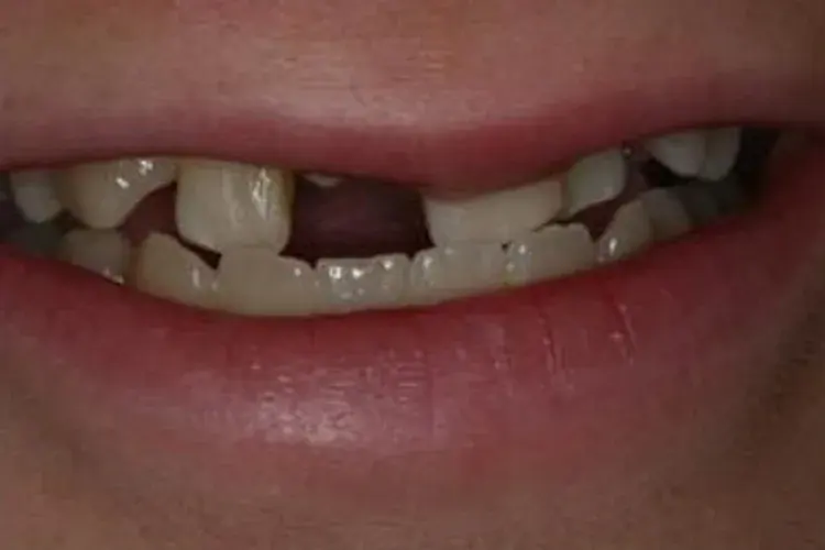 Before — a missing front tooth restored