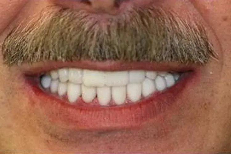 After — worn, discolored teeth brightened and evened