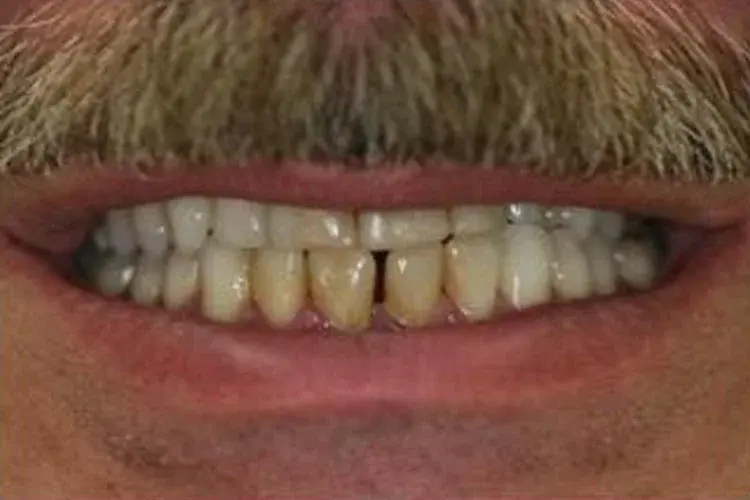 Before — worn, discolored teeth brightened and evened