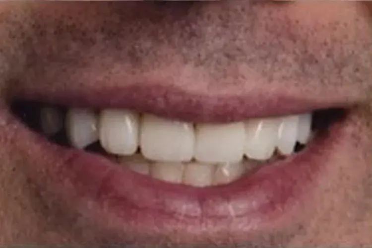 After — stained, worn teeth made new