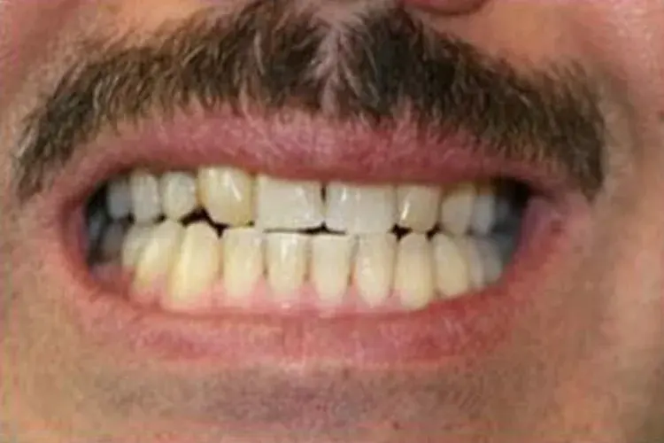 Before — stained, worn teeth made new