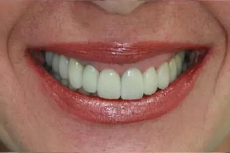 After — uneven teeth reshaped with porcelain