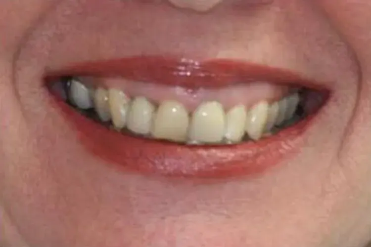 Before — uneven teeth reshaped with porcelain