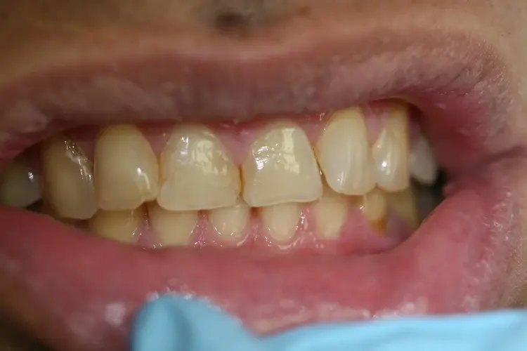 Close-up of a patient's teeth before treatment