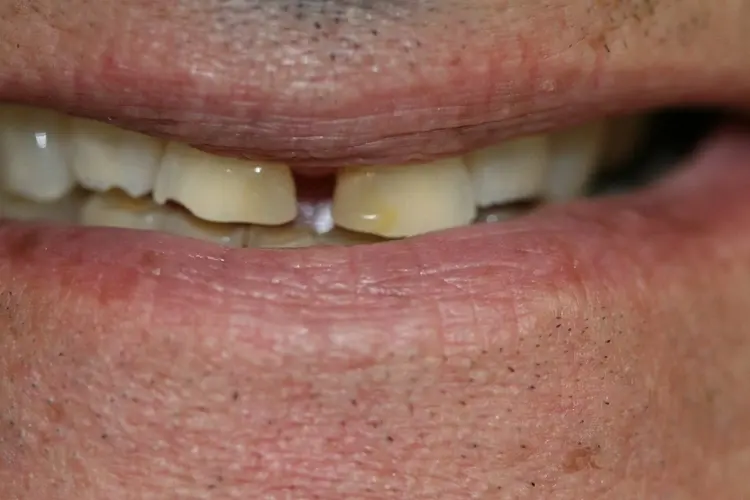 Patient's front teeth before treatment