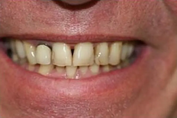 Close-up of a patient's smile before treatment