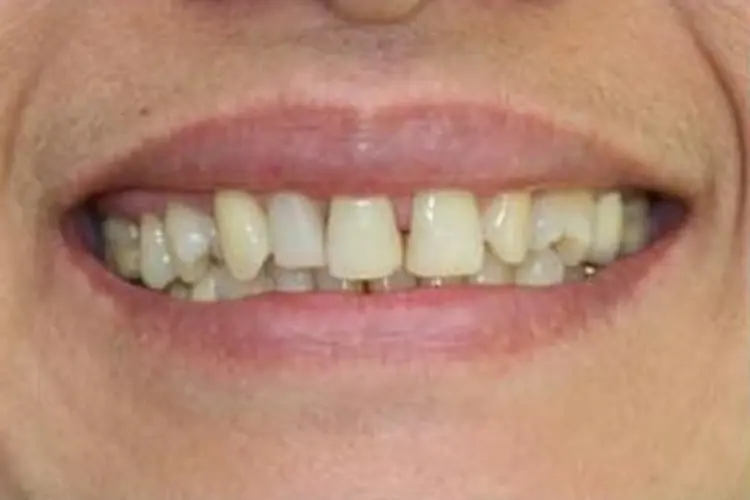 Patient's teeth before treatment