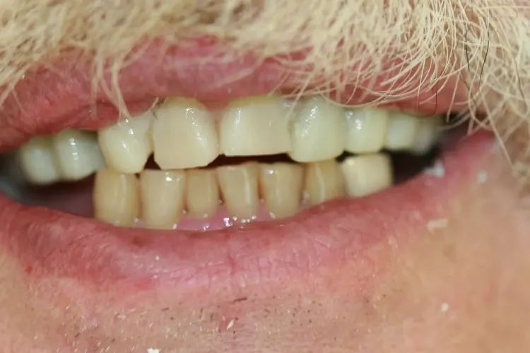 Close-up of a patient's teeth before treatment