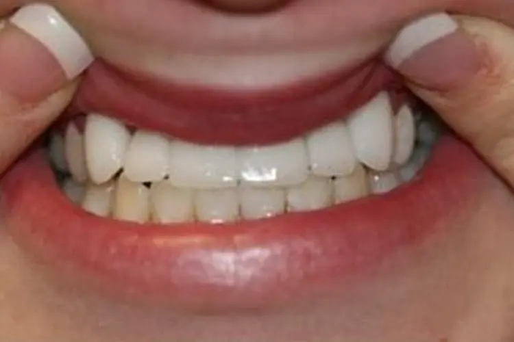 The same patient's restored smile after treatment