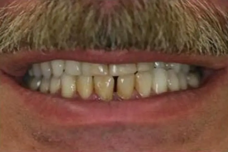 Close-up of a patient's smile before treatment