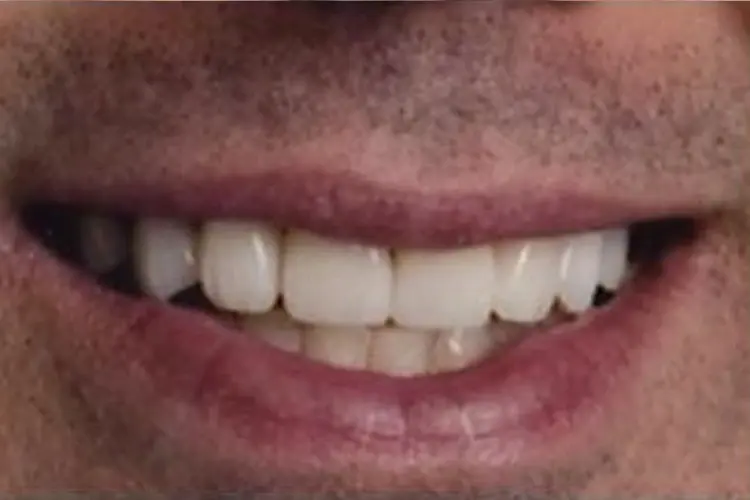 The same patient's front teeth after treatment