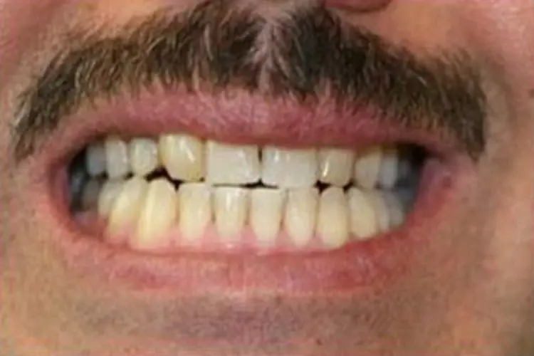 Patient's front teeth before dental treatment